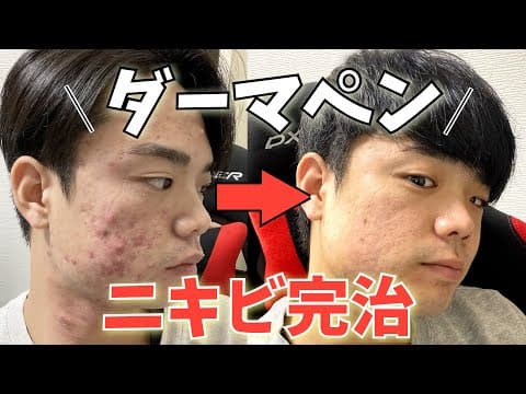 ニキビ肌、クレーター治すために初めてのダーマペン！施術の経過、費用、気になることを全てお話します。